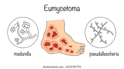 Chronic, specific granulomatous disease of fungal nature. Drawn fungi that provoke eumycetoma and the manifestation of the disease on the human leg. Medical vector isolated on white background.