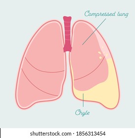 Chylothorax - anatomical scheme in hand drawn style. Gathering of chyle or lymph fluid in pleural space, type of pleural effusion. Patient-friendly infographic, vector medical scheme