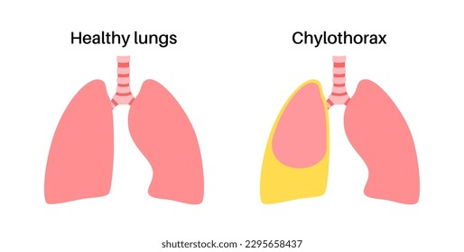 Chylothorax disease. Lymphatic fluid between layers of tissue in lungs and chest wall. Severe cough, chest pain, difficulty breathing. Unhealthy internal organs. Respiratory system vector illustration