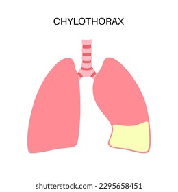 Chylothorax disease. Lymphatic fluid between layers of tissue in lungs and chest wall. Severe cough, chest pain, difficulty breathing. Unhealthy internal organs. Respiratory system vector illustration