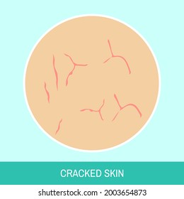 Circle Icon With Text Sign. Closeup Cracked Skin Vector Illustration. Image Of Skin With Irritation Close Up For Medical Articles, Posters And Banners.