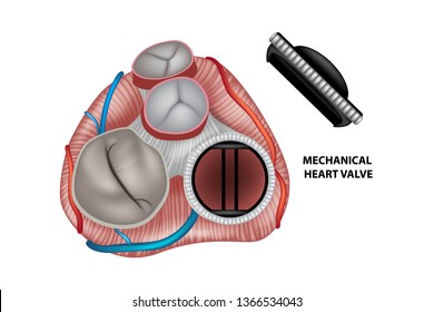 9 Valvular Prosthesis Images, Stock Photos & Vectors | Shutterstock