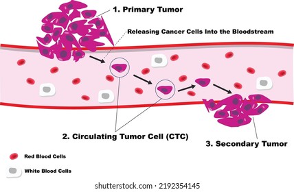 Circulating Tumor Cell Ctc Cell Cancer Stock Vector (Royalty Free ...