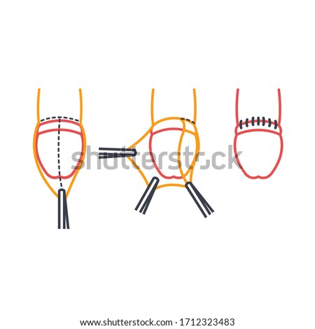 circumcision line icon, vector illustration 