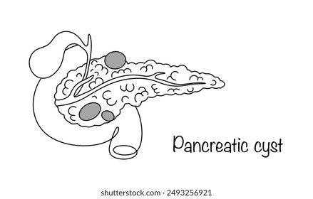 A circumscribed fluid formation that can be localized both inside and outside the pancreas. Pancreatic cyst. Hand drawn disease of the digestive organ. Vector.