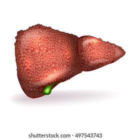Cirrhosis of the Liver anatomy illustration