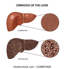 Cirrhosis Of The Liver. Histology Of The Healthy And Cirrhotic Liver With Corresponding Labels. Anatomical Vector Illustration In Flat Style Isolated Over White Background.