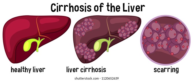 Cirrhosis of the liver illustration