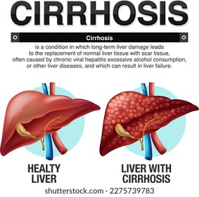 Cirrosis de la ilustración Infográfica Hepática