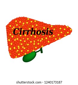 Cirrhosis of the liver. Infographics. Vector illustration on isolated background.