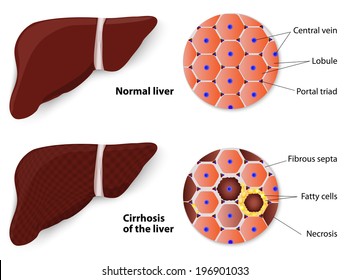 Cirrhosis Of The Liver And Normal Liver. Structure Of The Liver. Vector Diagram