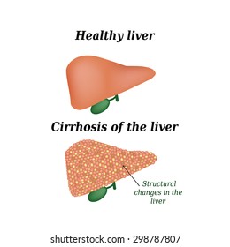 Cirrhosis of the liver. Vector illustration on isolated background