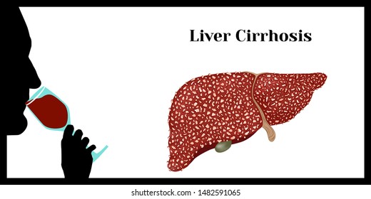 Cirrhosis. Violation of liver structure.