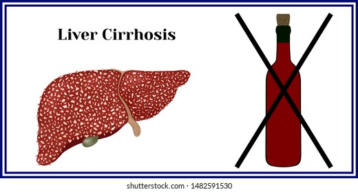 Cirrhosis. Violation of liver structure.