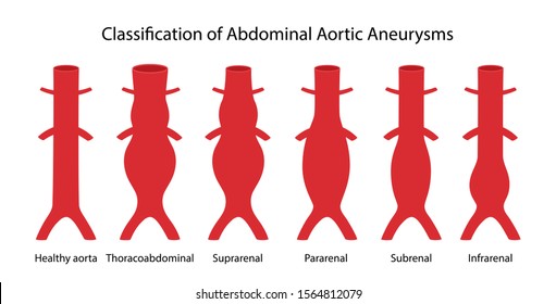 Different Types Of Aortic Aneurysms Aortic Aneurysm Abdominal Aortic Images