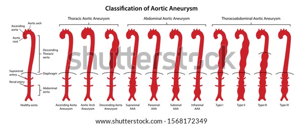 Classification Aortic Aneurysms Thoracic Abdominal Thoracoabdominal 9745