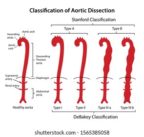 Classification of aortic dissection: Stanford, DeBakey. Healthy aorta with main parts labeled and aorta with various types of dissection. Vector illustration in flat style isolated on white background