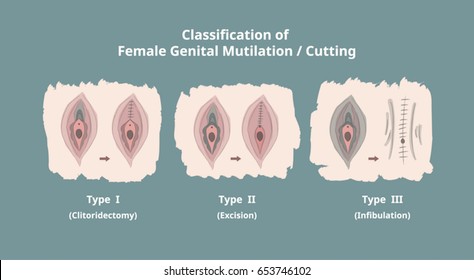 Classification of Female Genital Mutilation / Cutting (FGM/C) / Infographics / Elements