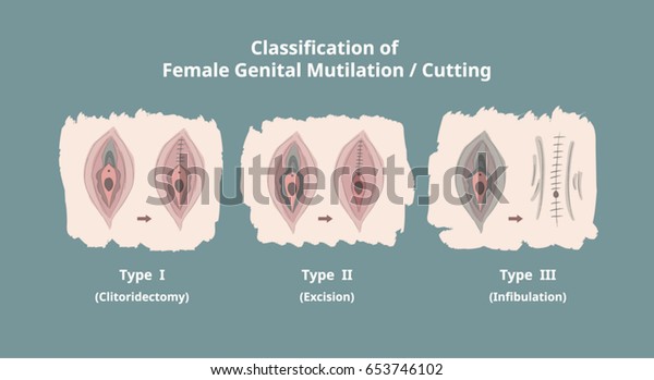 Classification of Female Genital Mutilation /\
Cutting (FGM/C) / Infographics /\
Elements