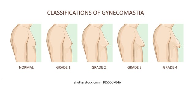 Classification of gynecomastia. Enlargement of the male breast