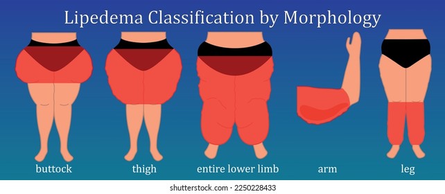 Classification of lipedema by morphology with red accent focus on problem fat zones. Weight health issues. Liposuction Educational Ad