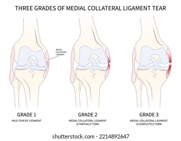 classification of Medial collateral ligament Injury test athletic meniscal femur pop hurt grade