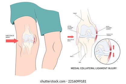 classification of Medial collateral ligament Injury test athletic meniscal femur pop hurt grade