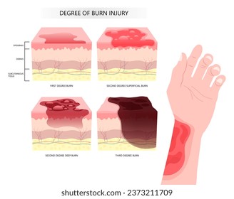 Classification for Skin burn injury degree of epidermis tissue layer with flames exposure