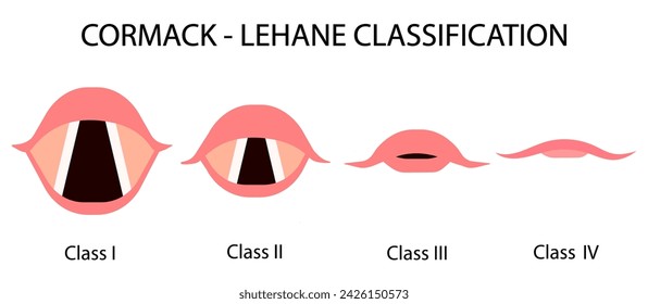 The Cormack–Lehane classification system classifies views obtained by direct laryngoscopy based on the structures seen. Medical procedure vector illustration isolated on white background.