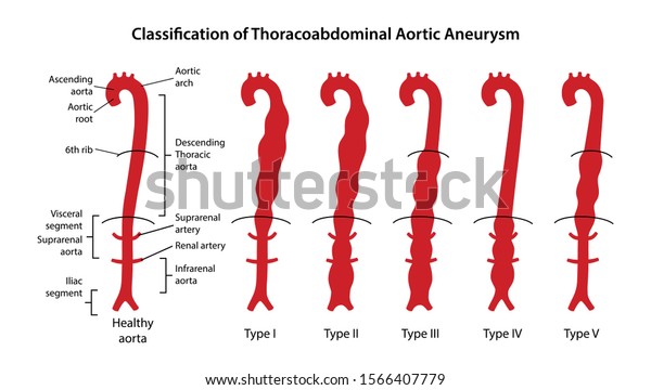 Classification Thoracoabdominal Aortic Aneurysms Healthy Aorta Stock ...