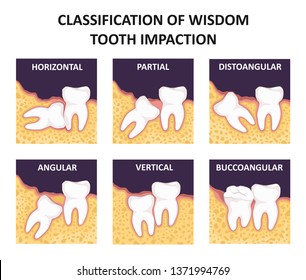 Classification of wisdom tooth impaction