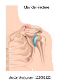 Clavicle Fracture