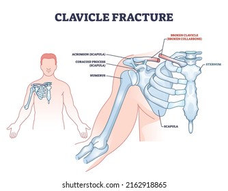 Clavicle fracture anatomy and broken shoulder collarbone outline diagram. Labeled educational scheme with anatomical hand and scapula skeletal joint vector illustration. Acromion and coracoid process.