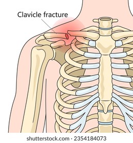 Clavicle fracture broken collarbone structure diagram schematic vector illustration. Medical science educational illustration