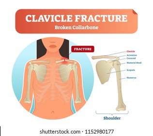 Clavicle Fracture With Broken Collarbone Vector Illustration. Medical And Anatomical Labeled Scheme With Clavicle Fracture, Acromion Coracoid, Humeral Head, Scapula And Humerus. Xray After Injury.