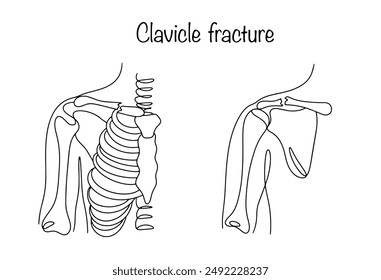 Clavicle fracture. Human skeleton from front to back showing a broken collarbone. Medical black and white illustration for different uses. Vector.