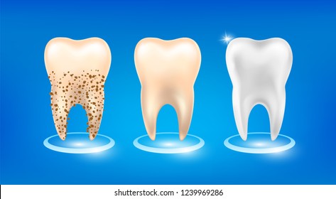 Clean and dirty tooth before and after whitening treatment. clearing tooth process. Set of 3d realistic Teeth Whitening on blue background. Vector illustration.