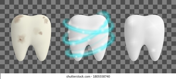 Clean and dirty tooth. Teeth Whitening process. Dental health design concept. Realistic vector illustration