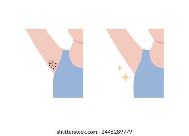 Clean and hairy dark problem underarm armpit icon. Before and after. Hair remove, beauty, laser treatment, waxing, body care concepts. Flat vector design isolated on white background illustration.