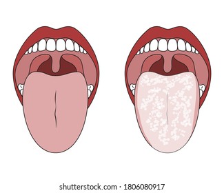 Lengua limpia saludable y lengua blanca recubierta. Lengua con Infección por Candida. Oral Thrush.