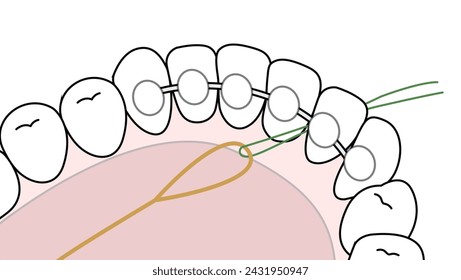 Clean Orthodontic retainer by floss, oral care - flat illustration 