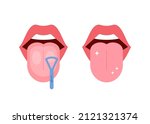 Clean tongue throat cleaner scraper in mouth. Before and after tongue cleaning. Halitosis prevention. Vector illustration