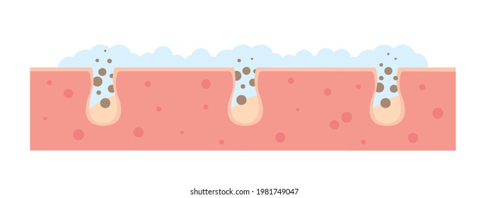 Cleaning blackheads process flat illustration. Clogged pores removal, skin cleaning foam, skincare. Can be used for topics like cosmetology, cosmetics. Shrinking and minimaizing face pores concept