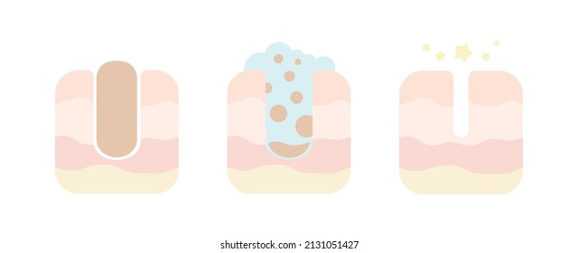 Cleaning clogged pores with foam flat illustration. Blackheads removal, exfoliation, skincare. For topics like cosmetology, dermatology, skincare. Shrinking and minimaizing face pores