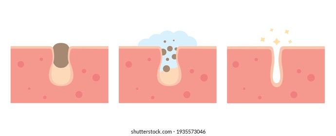 Cleaning clogged pores process flat illustration. Blackheads removal, skin cleaning foam, skincare. Can be used for topics like cosmetology, cosmetics. Shrinking and minimizing face pores concept