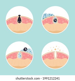 Cleaning clogged pores process flat vector illustration. Steps of blackheads, sebum or pimples removal, skin cleaning foam, skin care. Teenager skin. Shrinking and minimizing face pores concept.