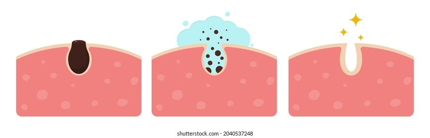 Cleaning clogged pores vector illustration. Skin care concept.