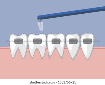 Cleaning metal braces on teeth using a special toothbrush for braces. Vector color illustration for orthodontists or dentists.