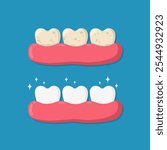 Cleaning and whitening teeth concept. Yellow teeth with plaque and white teeth in the gum. Comparison of dirty and clean teeth before and after cleaning. Dental care and oral hygiene design.