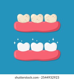 Conceito de limpeza e clareamento dos dentes. Dentes amarelos com placa e dentes brancos na gengiva. Comparação de dentes sujos e limpos antes e depois da limpeza. Cuidados dentários e design de higiene oral.